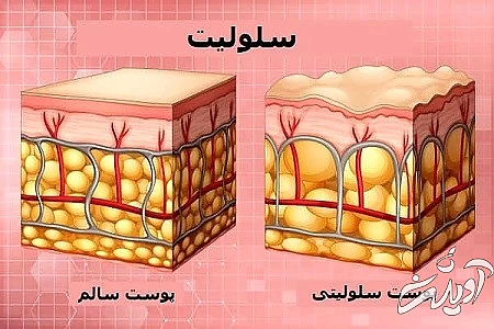 سلولیت در خانم ها بیشتر بوجود می آید کرم ضد سلولیت, درمان سلولیت پا, ورزش برای رفع سلولیت